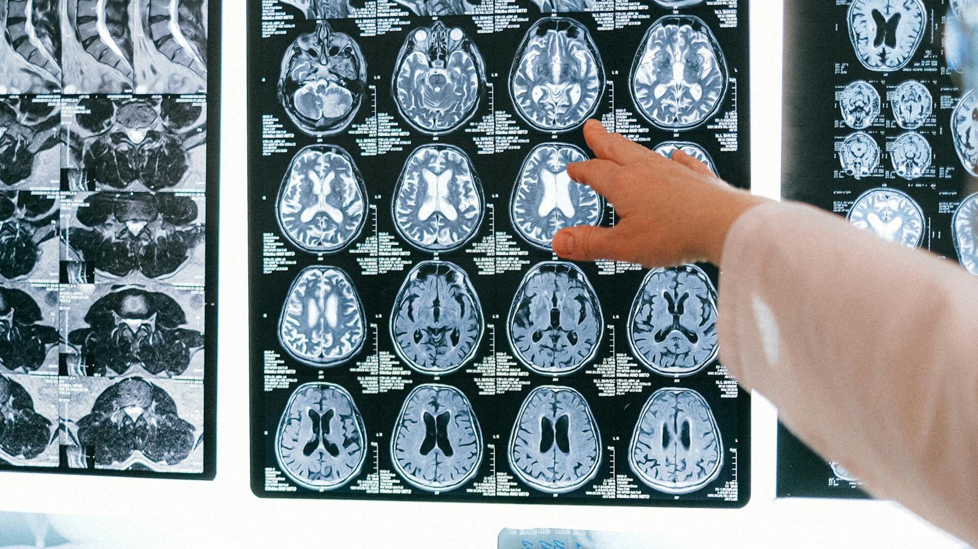 Estudio revela diferencias cerebrales en personas con rasgos psicopáticos y conductas antisociales