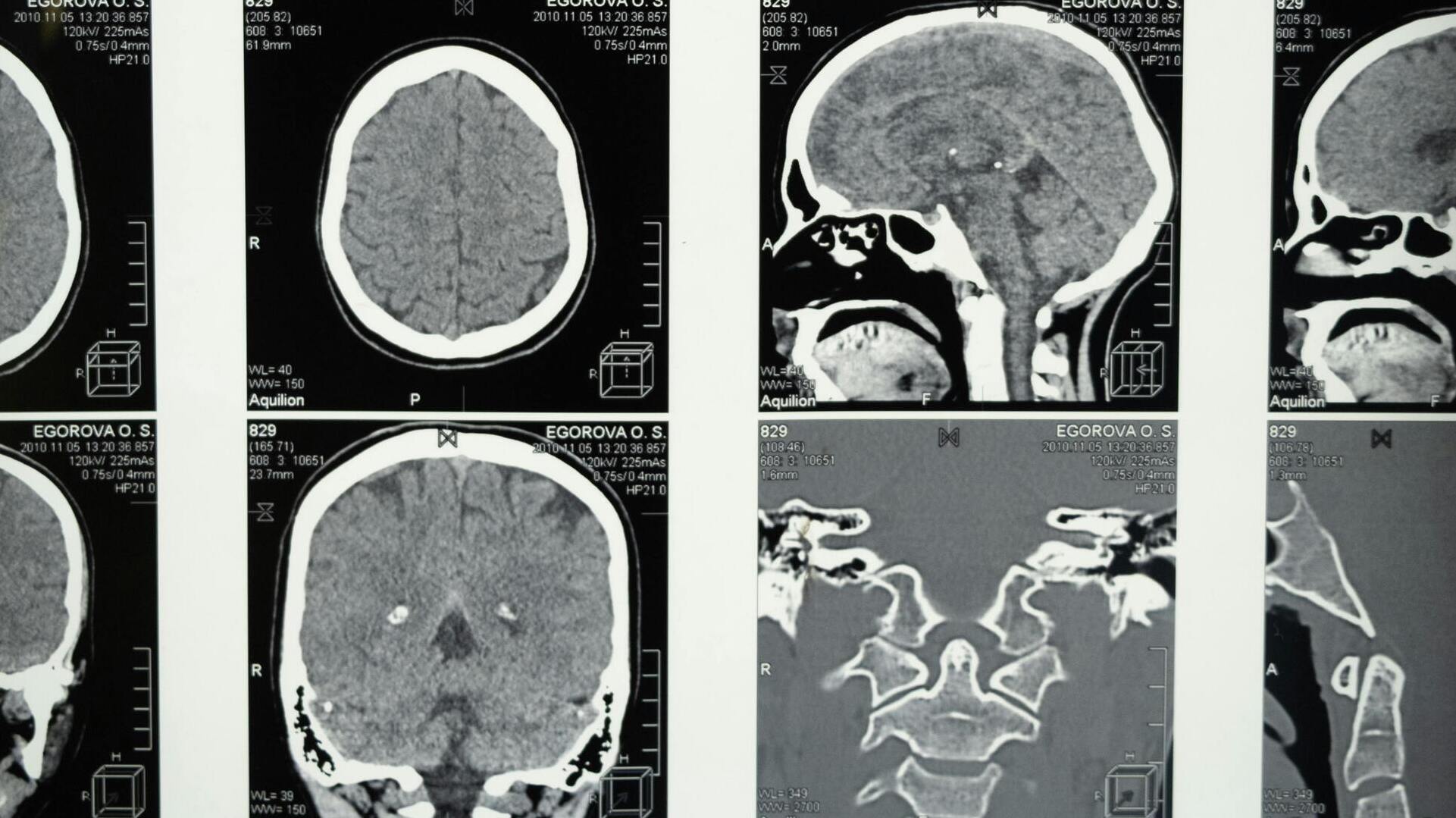 Un hallazgo que podría cambiar el futuro de la esclerosis múltiple