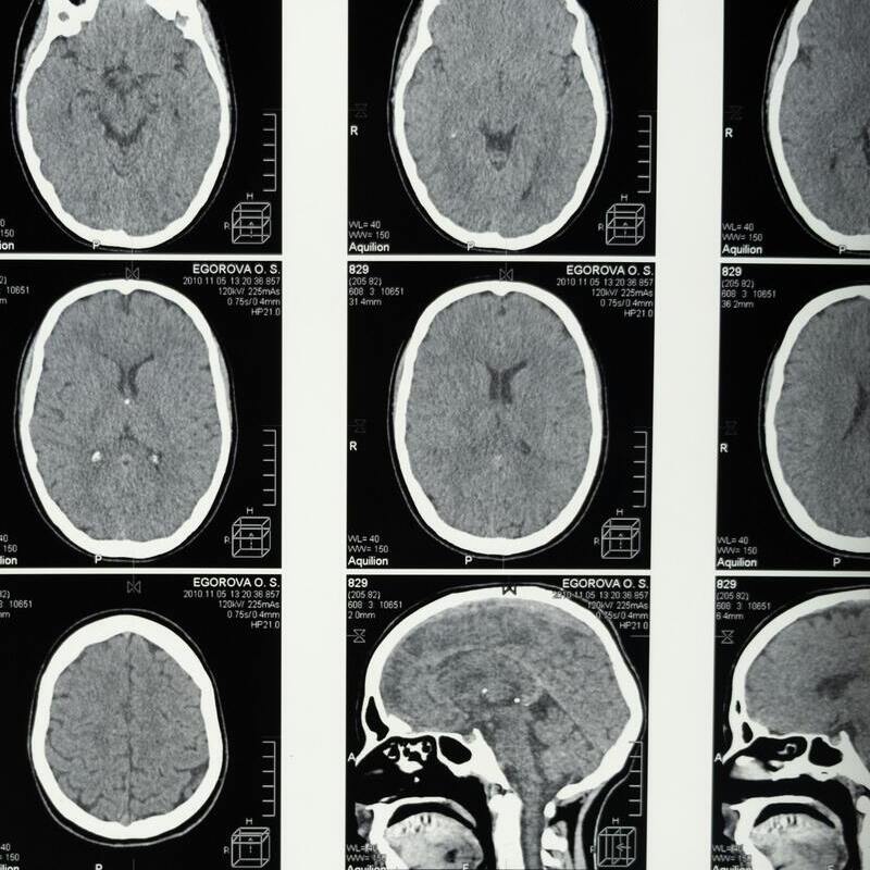 Imagen Un hallazgo que podría cambiar el futuro de la esclerosis múltiple noticia