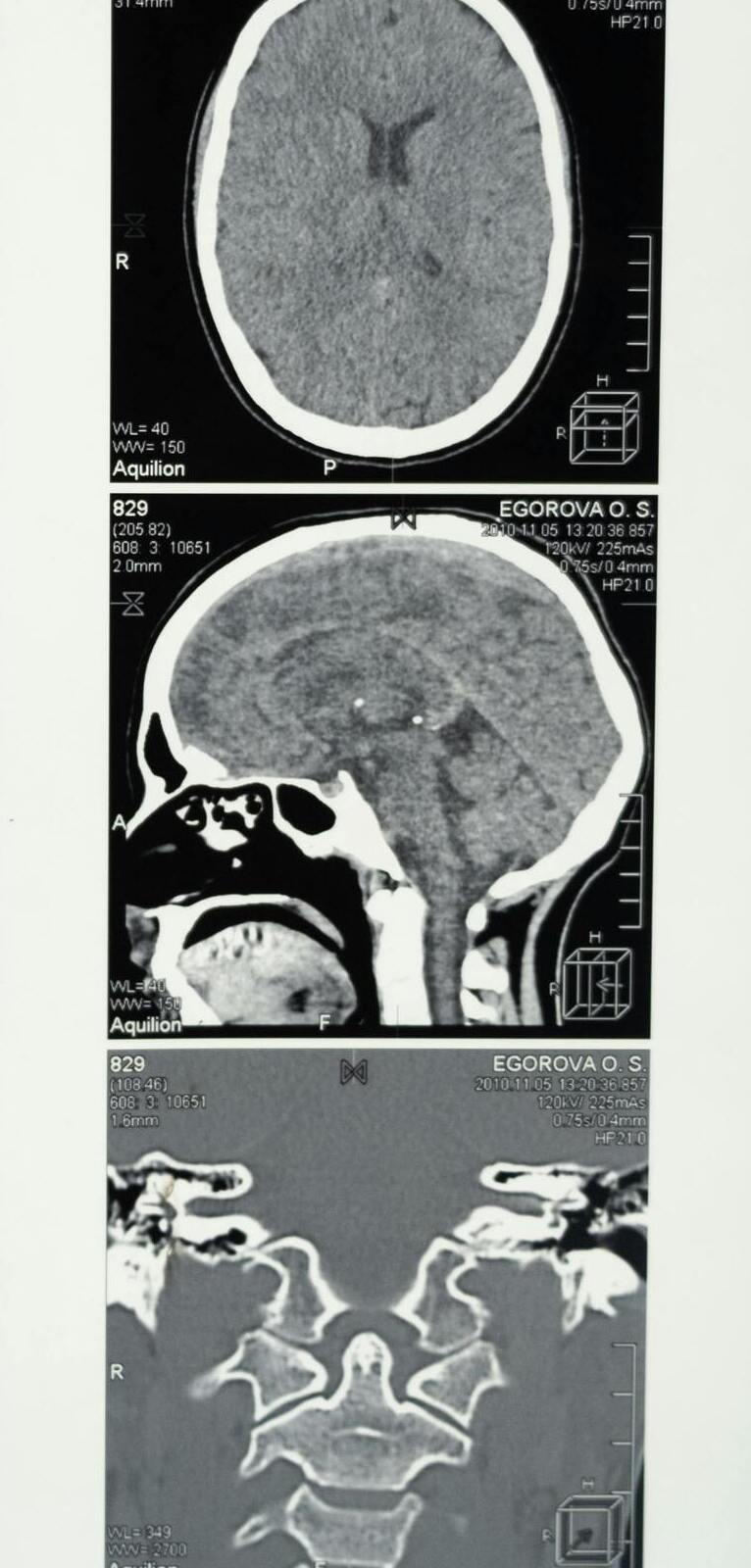  Imagen Un hallazgo que podría cambiar el futuro de la esclerosis múltiple noticia
